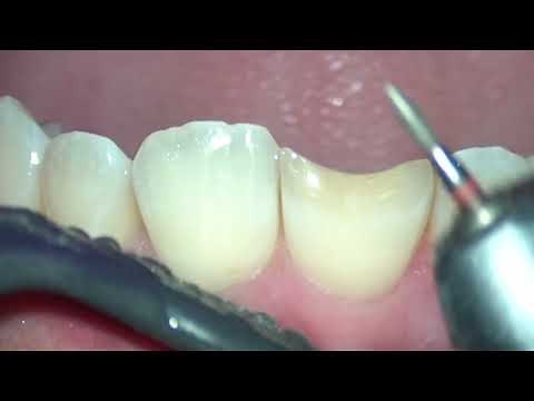 Beveling in Class IV Composite Restoration