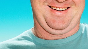 Double Chin Eliminator Injection: What to Know