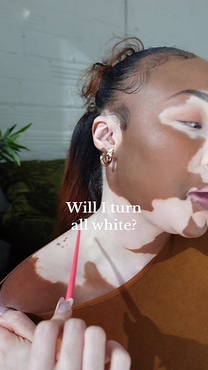 I get asked this question a lot and thought I’d talk about it a little more. Vitiligo is always changing it rarely stays the same. I’ve lost color and gained color my skin doesn’t always stay the same. I am currently in a season where my skin is re-pigmenting. Just wanted to share a little more of my story 🥰🫶🏾 #skinposi #vitiligoconfidence #vitiligo
