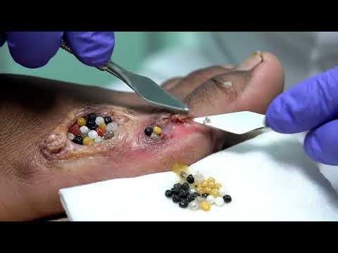 Mwangi’s Feet Jigger Infestation 😨 Deep Parasite Removal Treatment 😨1092