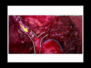 Explained The Laparoscopic Cholecystectomy Step-By-Step • Video • MEDtube.net