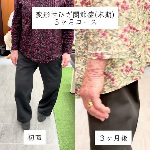 名古屋 変形性ひざ関節症の施術#変形性膝関節症 #半月板損傷