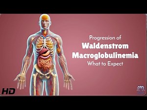 Waldenstrom Macroglobulinemia: Symptoms, Progression, and Treatment