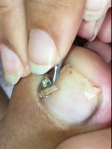 Unha Encravada Pedicure #unhas #pedicure #manicure