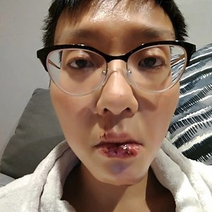 1.6K views | An Ottawa woman explains how a concussion upended her life for the last year: www.cbc.ca/1.5300461 | CBC Ottawa | Facebook