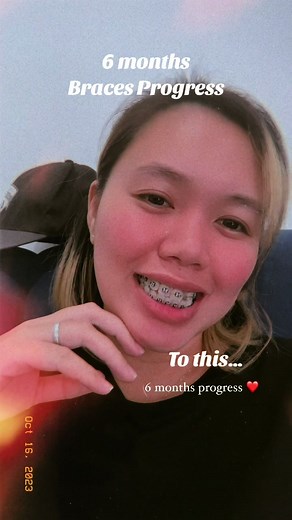 6 months braces progress #bracesjourney