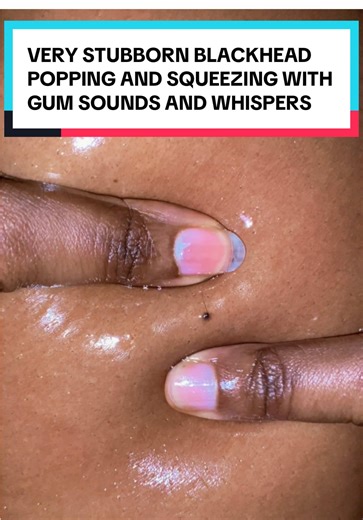 Stubborn Blackhead Popping ASMR: Satisfying Sounds
