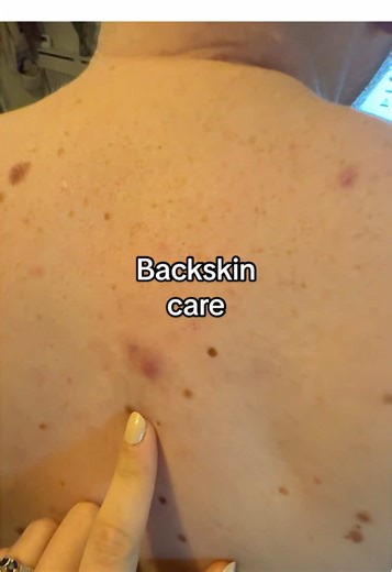 Skincare Routine for Back Acne Treatment