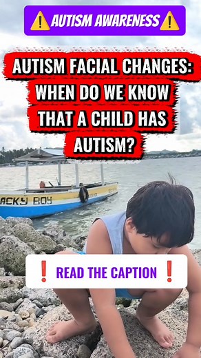 🧩 AUTISM FACIAL CHANGES: WHEN DO WE KNOW THAT A CHILD HAS AUTISM? There’s no specific “facial look” that can tell you a child has autism. Autism is a neurodevelopmental condition, not a physical one — meaning it affects how the brain develops and processes information, not the child’s appearance. However, some studies show that subtle facial differences may appear in some children with autism — especially in severe or syndromic forms (where autism comes with genetic conditions). These are not d