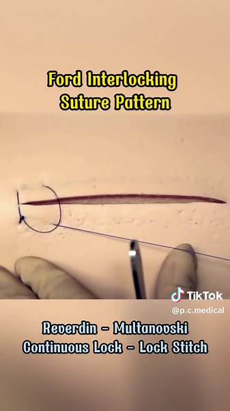 Ford Interlocking Suture Patterns in Surgery Explained