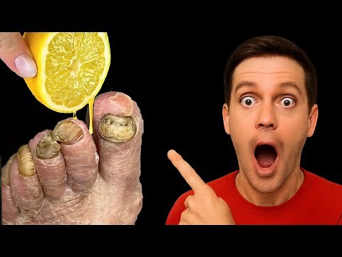 Foot Fungus Hack: Use THIS 3-Ingredient Mixture!