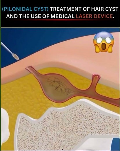 Laser Treatment for Pilonidal Cyst | Minimally Invasive Surgery with Faster Recovery
