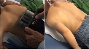 A magnetic, anesthesia-free MAGEC growth rod op. in action