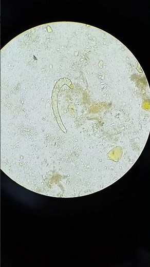 Stool examination under microscope 🔬