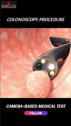 Colonoscopy procedure