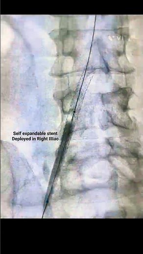 🩺 Right Iliac Artery Stenting – Procedure#Angioplasty #PeripheralStenting #VascularIntervention