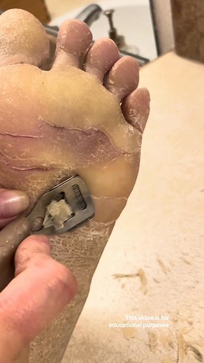 CRAZY CALLUS Shaving, Clipping, Rasping ASMR Pedicure - Hyperkeratosis EPPK Foot - Nov 2, 2023 | Fairy.freak