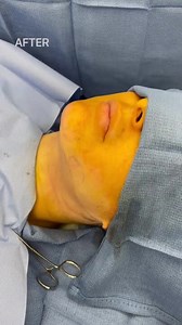 Chin Liposuction 3