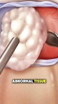 How Endoscopic Transnasal Tran sphenoidal Surgery Is Performed | Surgery Explained #medicaleducation
