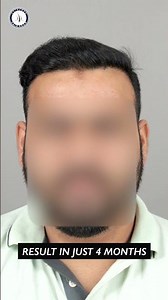 This hair transplant result will give you confidence
