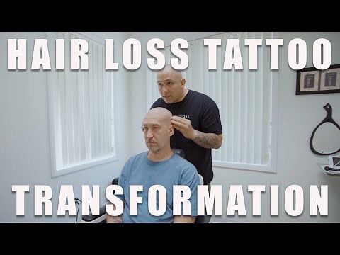 Hair Loss Tattoo Transformation (Scalp Micropigmentation)