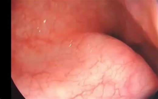 Endoscopia Terapêutica on Instagram: "👤 Paciente feminino, 50 anos, com queixa principal de dificuldade progressiva para engolir alimentos sólidos. História de disfagia intermitente evoluindo para sintomas mais persistentes nos últimos meses. 🩺 🎬Achados na endoscopia digestiva alta no vídeo acima. ❓Qual o diagnóstico????"