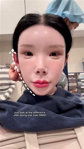 I tried Korea’s latest beauty trend Ear fillers and the results shocked me! 👂 Nowadays many peop...