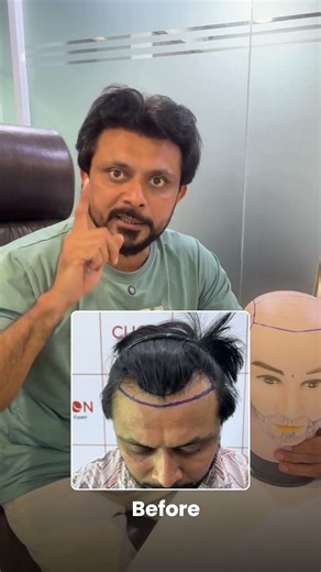 hair transplant journey | hair transplant gujarati