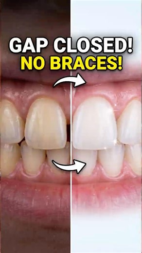 Gap Between Front Teeth Fix 😱 | Closing Spaces Without Braces