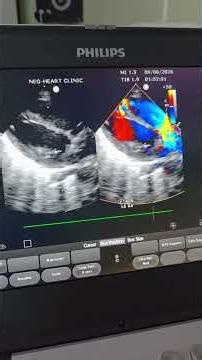 Lower Septal Muscular VSD on Neonatal fECHO: Measuring Defect Size & Doppler Flow in Moderate PPHN