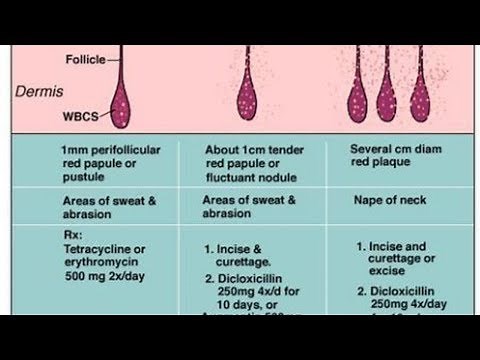 What’s the Difference Between a Furuncle and a Carbuncle? | Tita TV