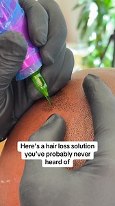 78 reactions · 33 shares | Dealing with hair loss? We've got you covered! Scalp micropigmentation is a safe, non-surgical solution that uses tiny impressions to mimic hair follicles, giving you a realistic, long-lasting look of short hair! Book your free consultation to get started today. | Scalp Micro USA | Facebook