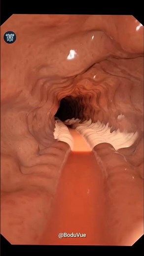Inside Your Colon: What Constipation Looks Like (3D Endoscopy) in 3D Animation #humanbody #anatomy