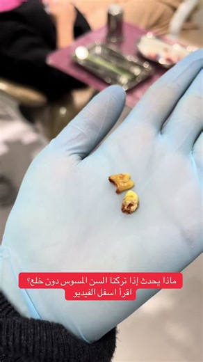 إذا تركت السن المسوس دون خلع، فهناك عدة عواقب محتملة: \t1.\tتفاقم التسوس: التسوس سيزداد عمقًا ويصل إلى لب السن، مما يسبب ألمًا شديدًا. \t2.\tالتهاب الأسنان أو الخراج: يمكن أن يتكوّن خراج في جذر السن، مما يؤدي إلى تورم وألم شديد. \t3.\tتأثر الأسنان المجاورة: العدوى يمكن أن تنتقل للأسنان القريبة وتسبب تسوسًا أو التهابات. \t4.\tمشاكل في اللثة والفك: الالتهاب المزمن قد يؤدي إلى مشاكل في اللثة أو فقدان عظم الفك حول السن. \t5.\tألم مستمر وصعوبة في المضغ: قد يصبح تناول الطعام مؤلمًا ويؤثر على نوعية الح