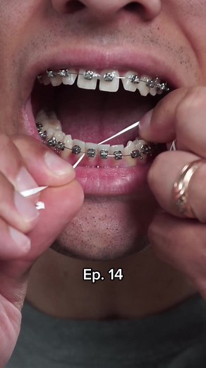 How to Floss Teeth with Braces: Step-by-Step Guide