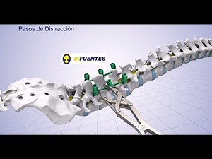 Fijación Con Tornillos Poliaxiales