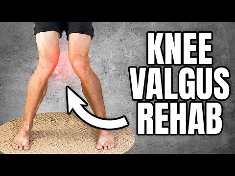 Knock Knees Correction (Knee Valgus Exercises)