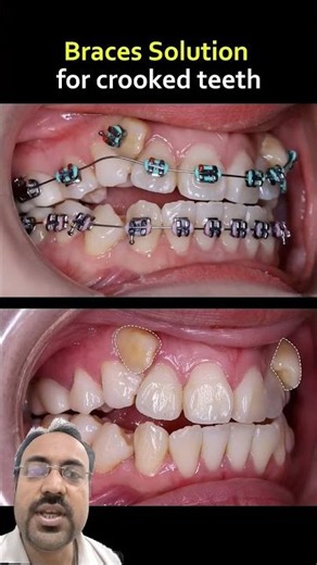 Teeth Alignment correction in 2 minutes .#braces #trend #teeth #2million #youtube