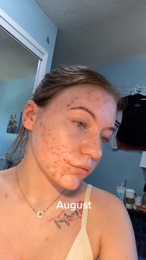 Forgot this in the drafts, definitely some huge progress 🥰 #proactiv #acne #skincare (sorry y’all had to see my side profile rip)
