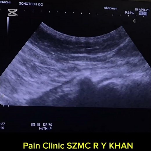 Caudal epidural Steroid injection for Lower back ache with Curvilinear probe