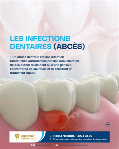 Les infections dentaires ne doivent jamais être ignorées. Un abcès dentaire est une infection bactérienne sérieuse pouvant provoquer douleurs intenses, gonflement et complications si elle n’est pas traitée à temps. 👉 Une prise en charge rapide permet d’éviter la propagation de l’infection et de préserver votre santé bucco-dentaire. Si vous ressentez une douleur persistante, une sensibilité inhabituelle ou un gonflement des gencives, consultez sans attendre. 📍 Premium Dental Clinic 📞 Prenez re
