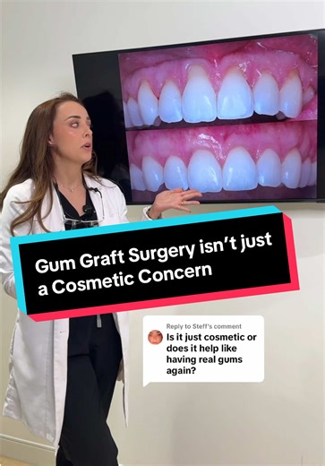 Understanding Gum Grafting: More Than Just Aesthetic