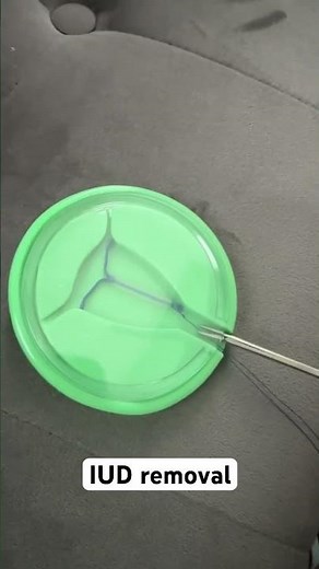 IUD removal