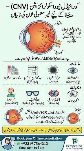 Choroidal Neovascularization (CNV) | Choroid | #retina #eyeinfection