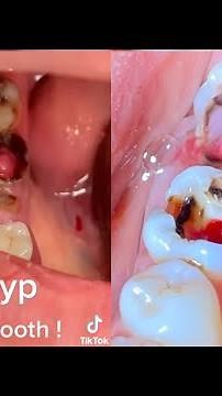 Pulp polyp, interesting #tiktok #video