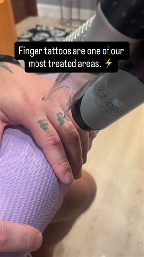 We see finger tattoos on a daily basis. Whether it’s for job purposes, an ex’s name, a date, or just the location itself. Whatever the reason, we are here for you. Multiple sessions are needed for full removal. Treatment 1 is done and is fast!! ⚡️ Stay tuned for updated results. #atlanticlaser #tattooremoval #tattoolifestyle #laser #lasertattooremoval #lasertattooremovalspecialist #best #results #holdfast #holdfasttattoo #tuesday #newbeginings #goodluck #trusttheprocess #knuckletattoos #careerch