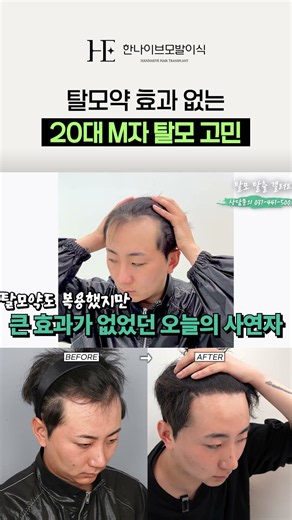 비절개 모발이식 3500모 1년 후기