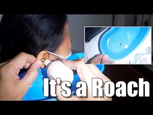 Cockroach Stuck for Days Inside Woman's Ear Removed