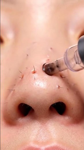 “Extreme Blackhead Suction Before & After — Clear Skin Results!”