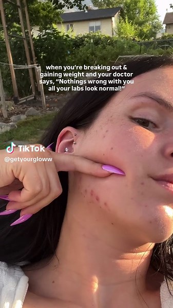 Balancing PCOS: My Personal Journey and Tips